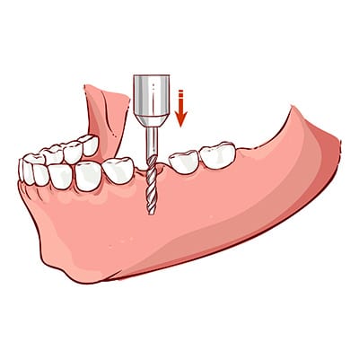 Dental Implant Surgery | Dentist Mount Waverley