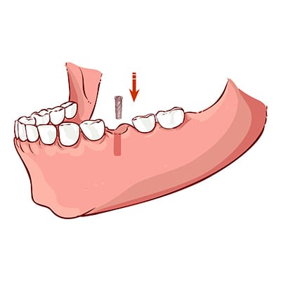 Placing the dental implant