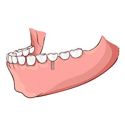 Placing the dental crown | Dental implant procedure