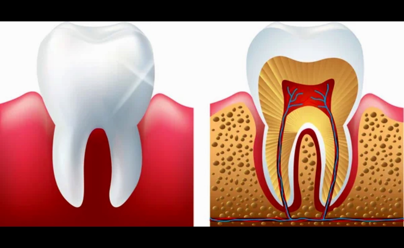Root canal Before-and-after