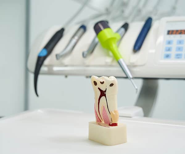 root canal treatment mount waverley